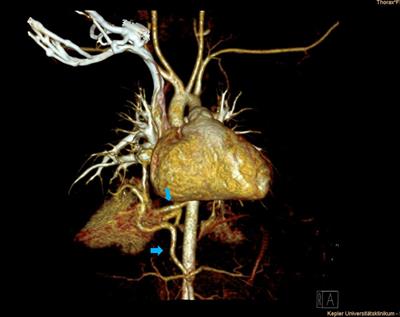 Vascular Anatomy in Congenital Lung Lesions—Description and Classification